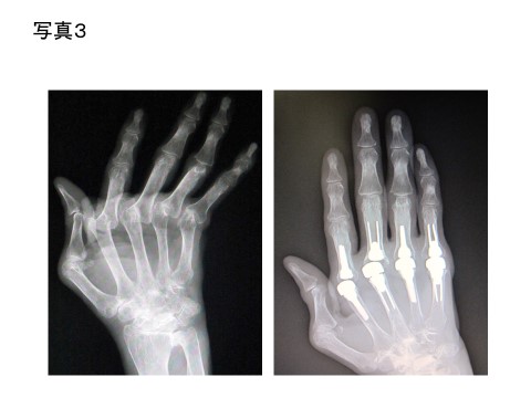 写真３：指の人工関節置換術（リウマチの尺側偏位、MP人工関節）
