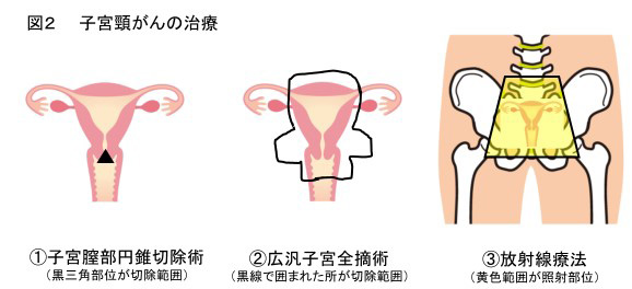 図２：子宮頸がんの治療