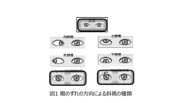 図１：眼のずれの方向による斜視の種類