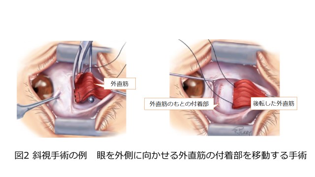 図２：斜視手術の例　眼を外側に向かせる外直筋の付着部を移動させる手術
