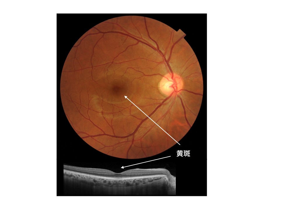 写真１：上は正常な眼底写真（中央に黄斑が位置する）。下は黄斑の断面構造