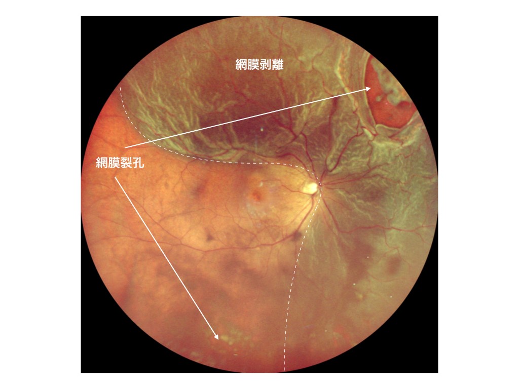 写真２：網膜剥離の眼底写真。複数の網膜裂孔と黄斑に迫る網膜剥離
