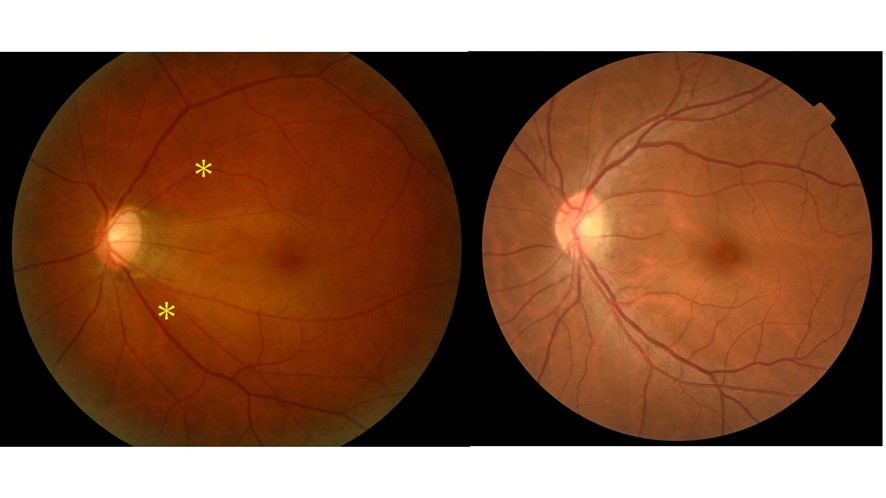 写真１ーA：緑内障の眼底写真（A左）と光干渉断層計写真（B左）と、正常の眼底写真(A右)と光干渉断層計写真（B左）。