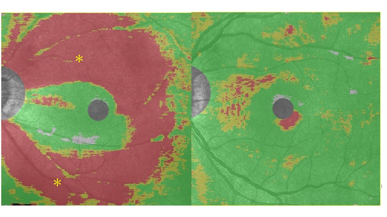 写真１ーB：緑内障の眼底写真（A左）と光干渉断層計写真（B左）と、正常の眼底写真(A右)と光干渉断層計写真（B左）。