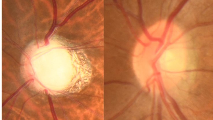 写真２：緑内障の視神経乳頭（左）と正常の視神経乳頭（右）。