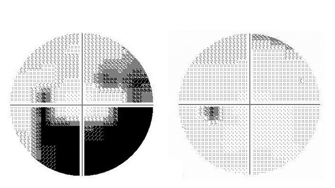 写真３：緑内障によって狭窄した視野（左）と、正常の視野（右）。