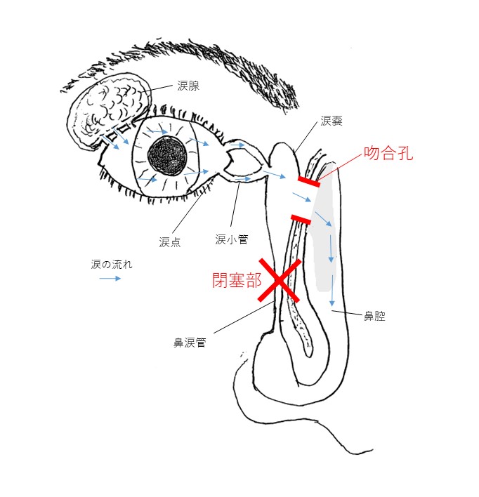 図３：鼻涙管閉塞症と涙嚢鼻腔吻合術