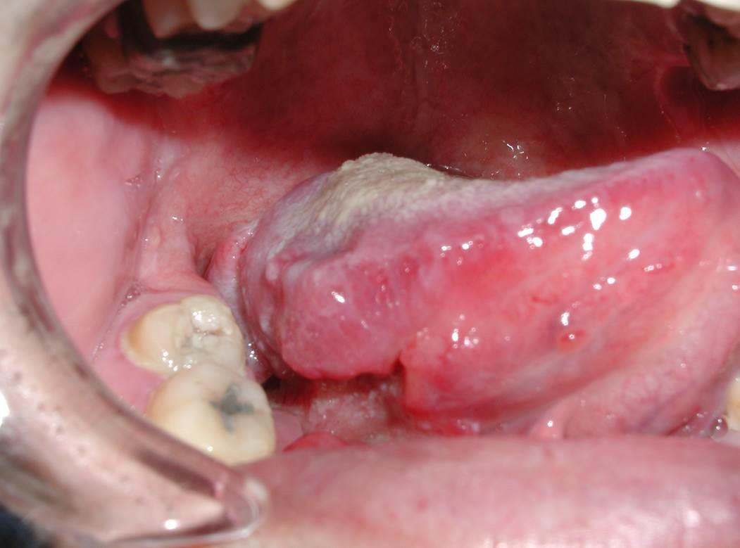 写真１：舌がん（右舌縁にしこりと潰瘍が生じています）