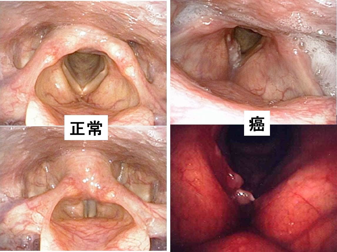 写真２：咽頭がん（右声帯に腫瘍が認められます）