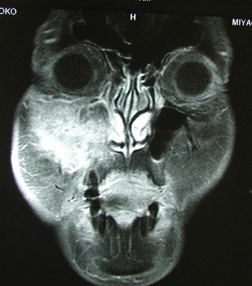 写真３：上顎がん（右上顎洞を占拠する腫瘍が認められます）