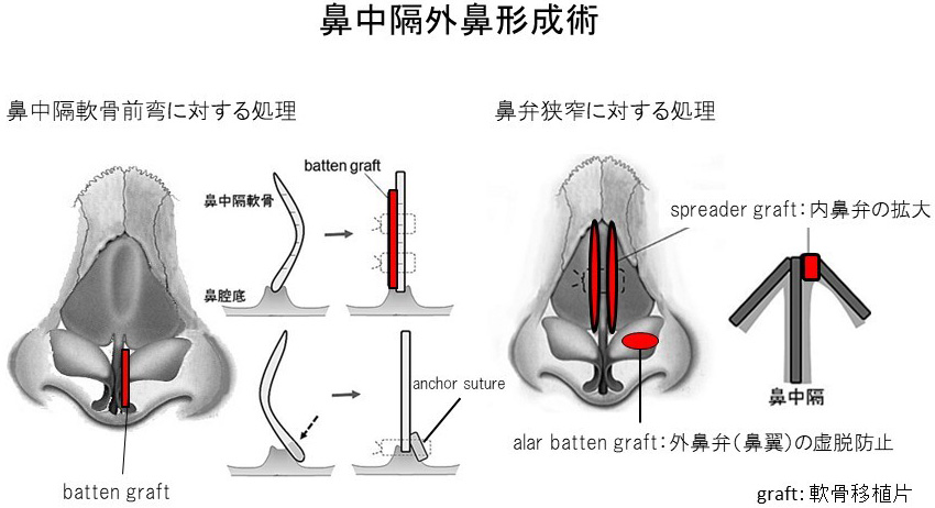 図３：鼻中隔外鼻形成術の手術手技