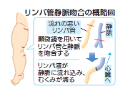 図１：リンパ管静脈吻合の概略図