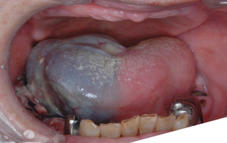 写真１：舌に発生したがんに対する動注化学療法(青色の部分は抗がん剤が流入する領域)
