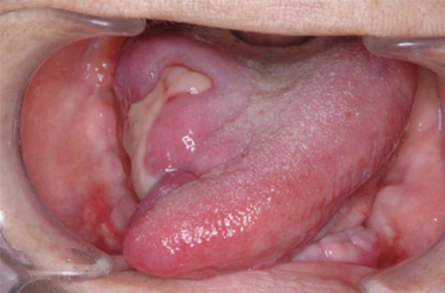 写真２：動注化学療法でほとんどのがんが消失し、放射線治療による舌の温存が可能となりました。