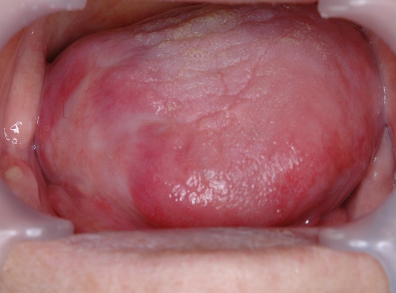 写真３：放射線治療で治癒した後の口腔内