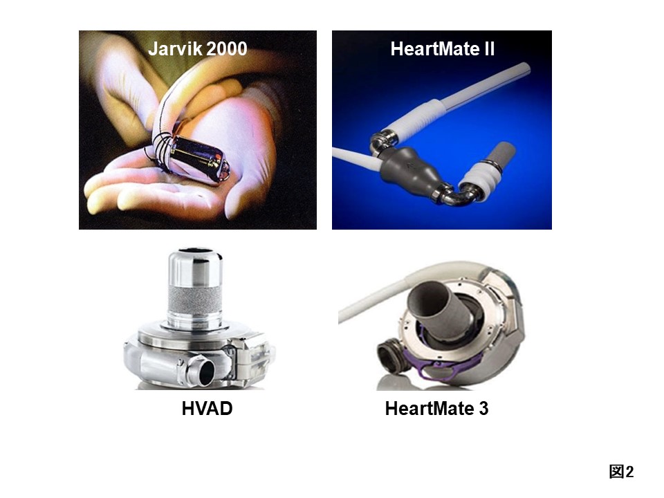 図２：植込型補助人工心臓
さまざまなタイプの機械が開発されていて、より小型で高性能なタイプが使えるようになってきました。