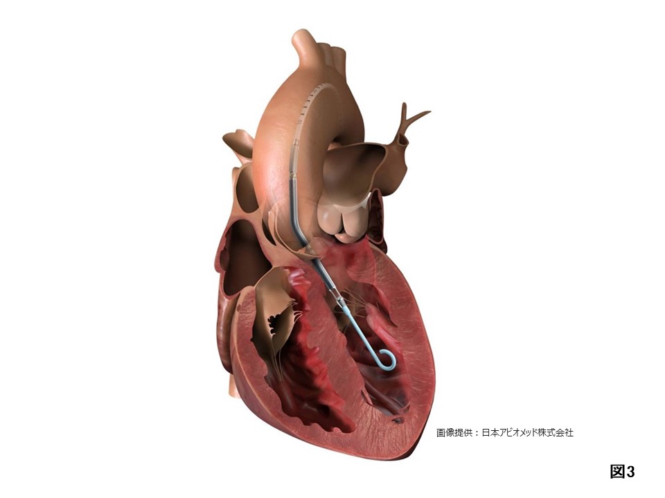 図３：カテーテルによる補助人工心臓
足の付け根からカテーテルを入れることで、心臓のはたらきを助ける小型のポンプを、胸を開けることなく心臓の中に入れることができるようになりました。