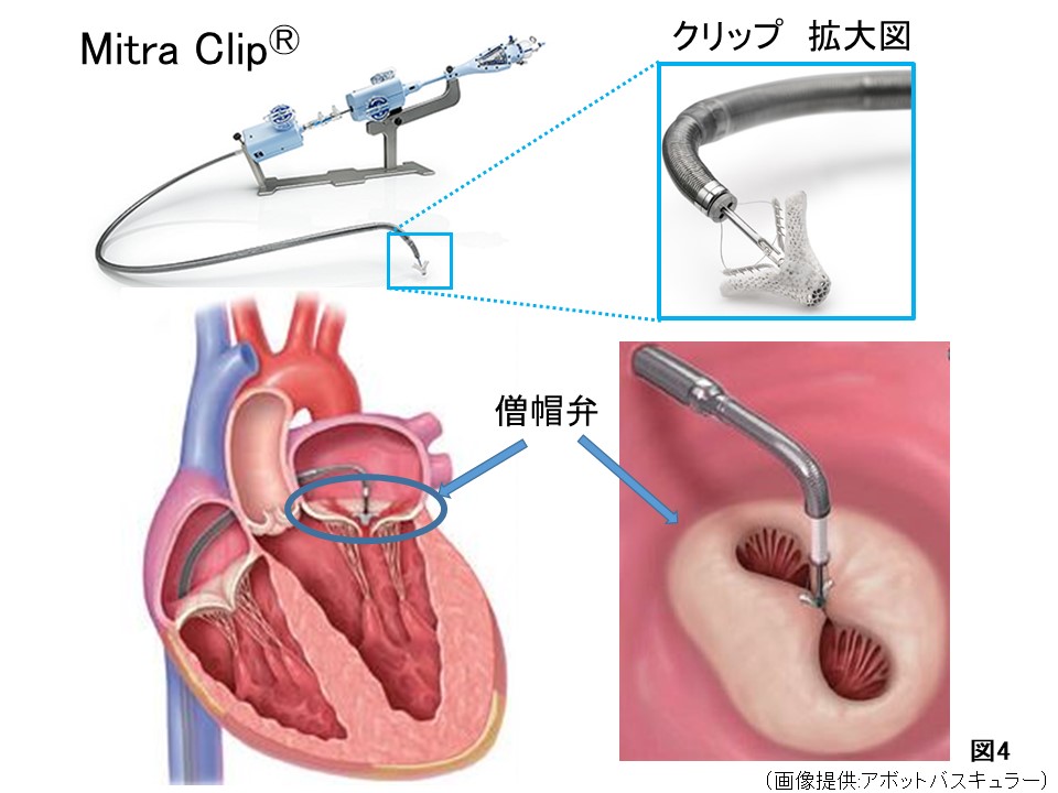 図４：経皮的僧帽弁形成術
足の付け根から心臓までカテーテルを入れることで、広がった僧帽弁を小型のクリップで閉じて、逆流を治します。