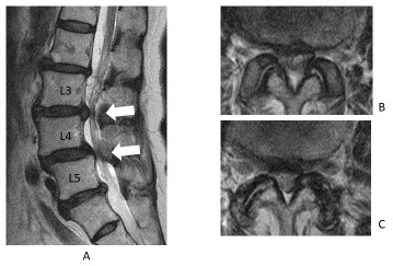 図１：60歳代男性、腰部脊柱管狭窄症。