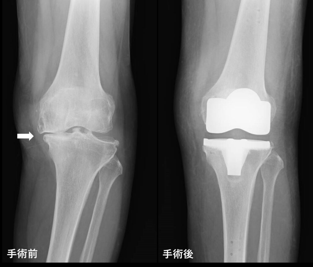 写真１：手術前（左）後（右）のX線。軟骨が摩耗し膝関節の隙間が無くなっています（矢印）。