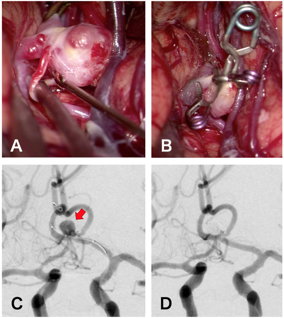 図２：くも膜下出血の脳動脈治療
A）顕微鏡で見た脳動脈瘤
B）脳動脈瘤にクリップをかけた後
C）血管撮影所見（矢印：脳動脈瘤）
D）脳動脈瘤コイル塞栓術を行った後