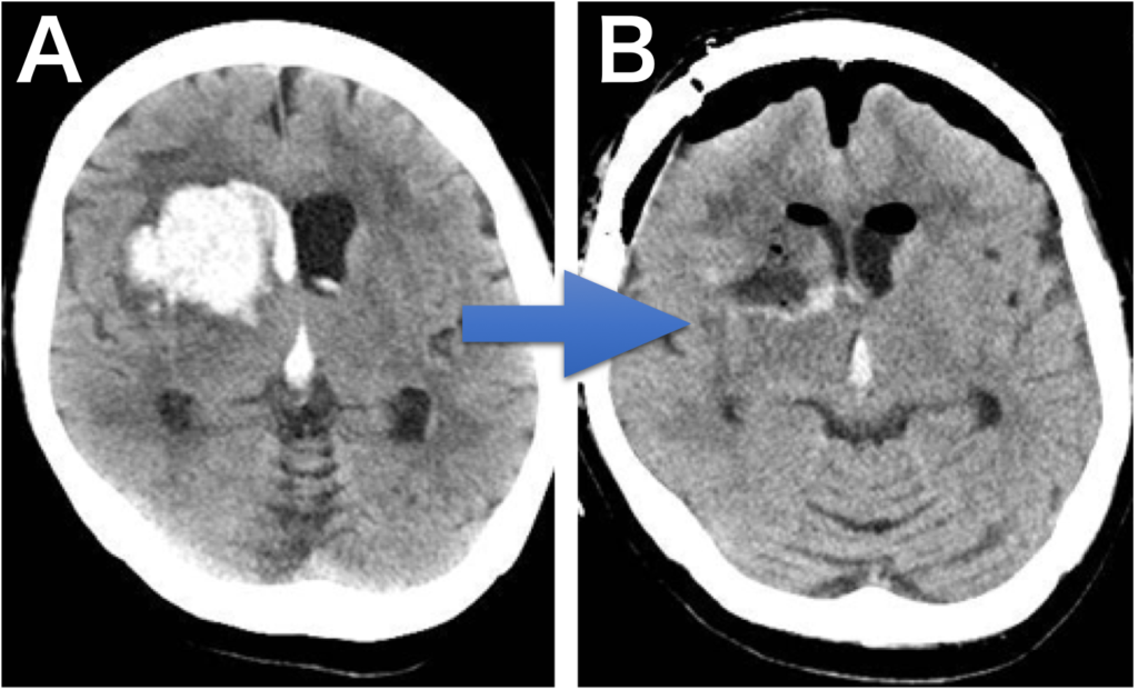 図３：A）脳出血の頭部CT
B）開頭血腫除去術を行った後
