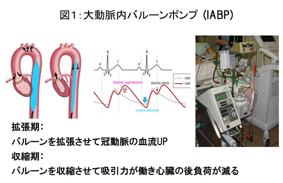 図1:大動脈内バルーンポンプ（IABP）