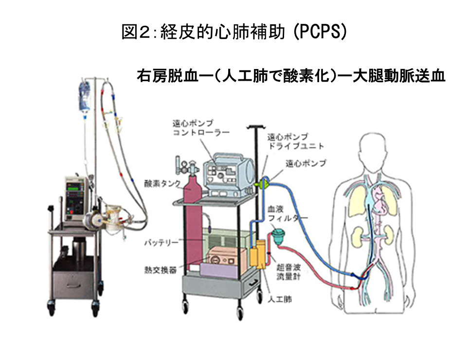 図2:経皮的心肺補助（PCPS）