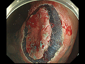 早期の食道・胃・大腸がんに対する内視鏡治療