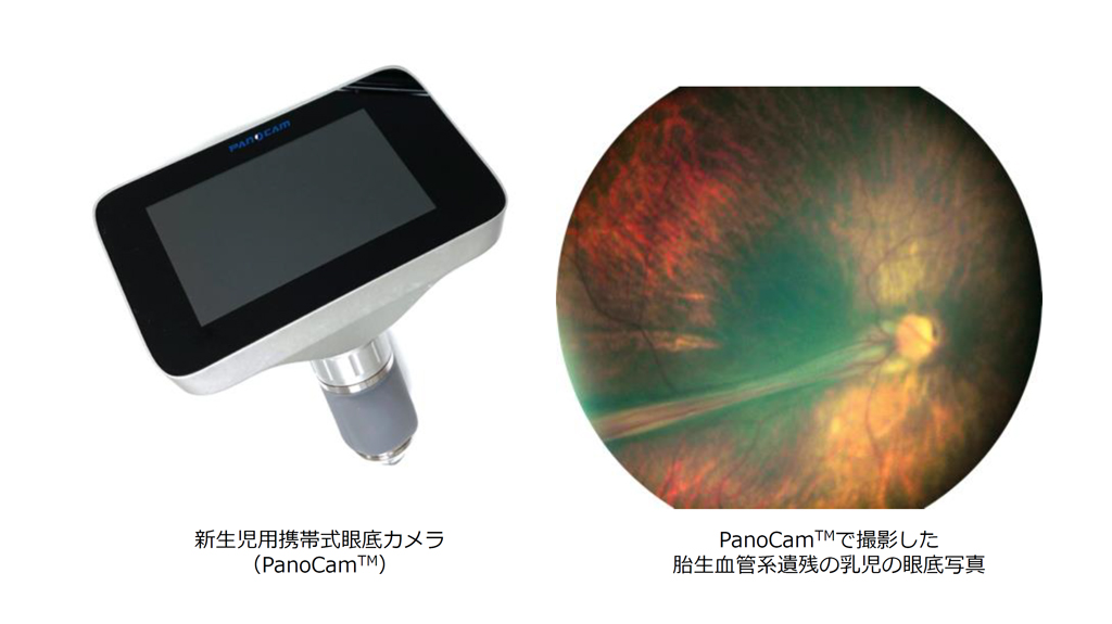 新生児用携帯式眼底カメラ　PanoCamTMで撮影した胎生血管系遺残の乳児の眼底写真
