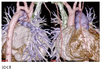 3DCTによる心臓の3Dイメージ